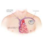 implantation-of-cardiovascular-defibrillators-01-150×150