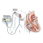 catheter-based-cardiac-ablation-01-150×150